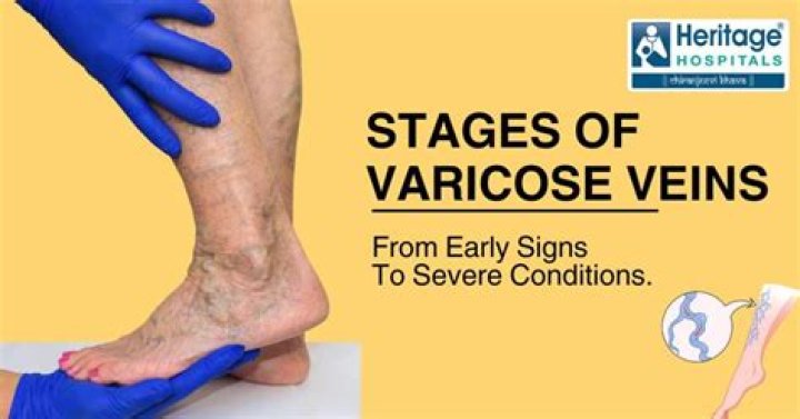 Are ropey veins dangerous?