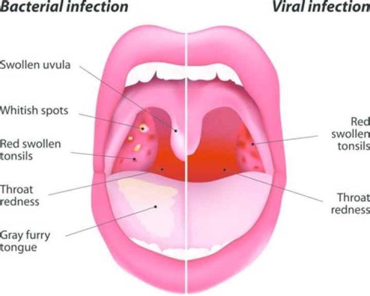 Are throat infections contagious?