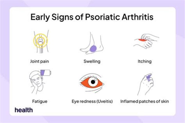 At what age does psoriatic arthritis start?