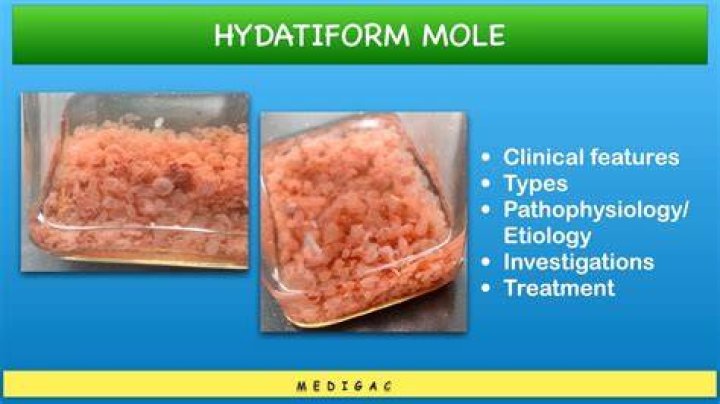Can a hydatidiform mole have a heartbeat?