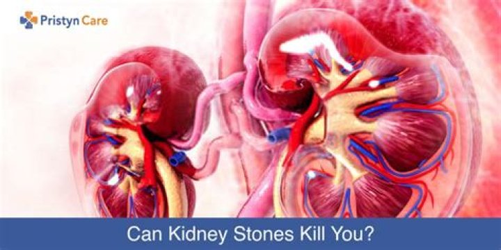 Can kidney stone kill you?