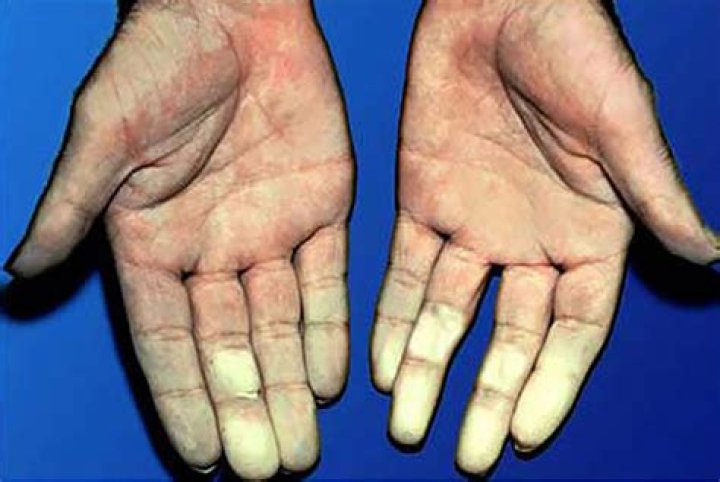 Can raynaud's cause red hands?