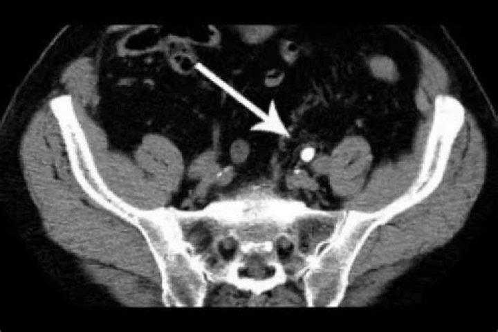 Does iv contrast obscure kidney stones?