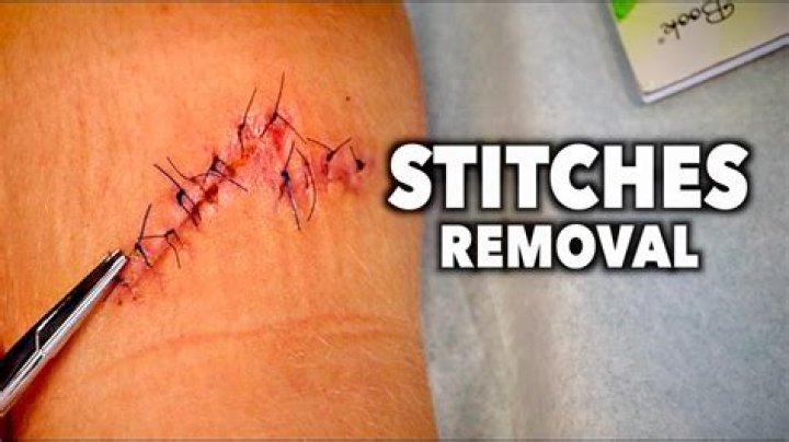 Does removal of stitches hurt?