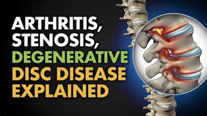 Is degenerative disc disease arthritis?