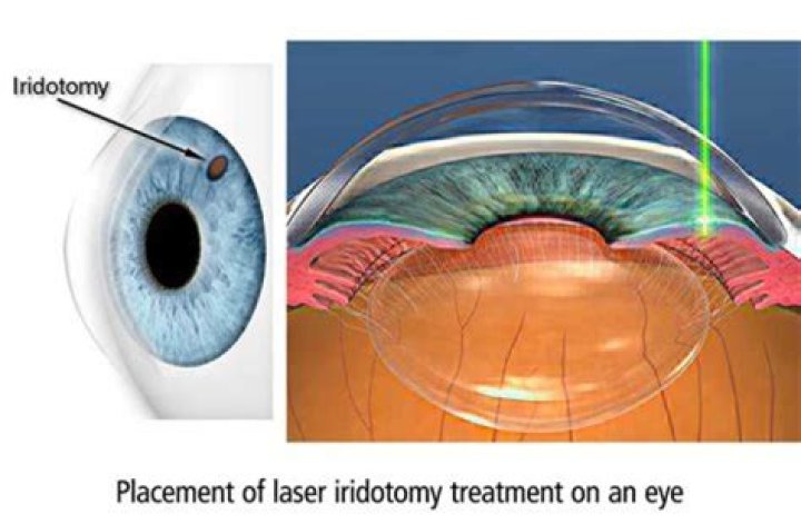 Is iridectomy a medical term?