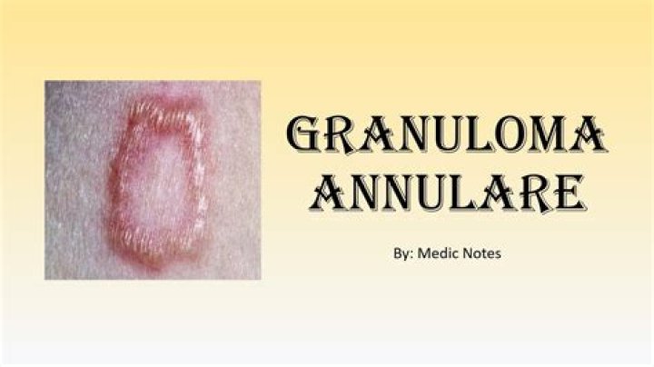 Should i pop my granuloma?