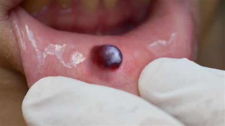 Should you prick a blood blister?