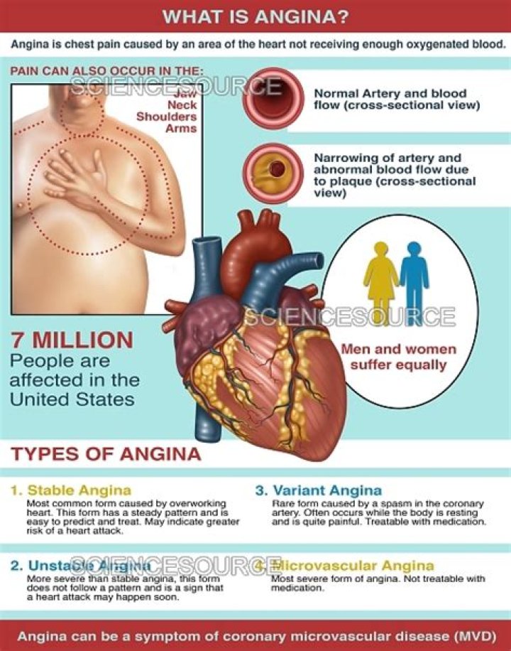 Where angina pain is located?