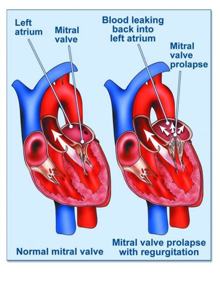 Who gets mitral valve prolapse?