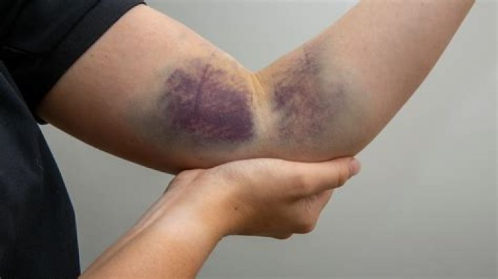 Why won't my contusion heal?