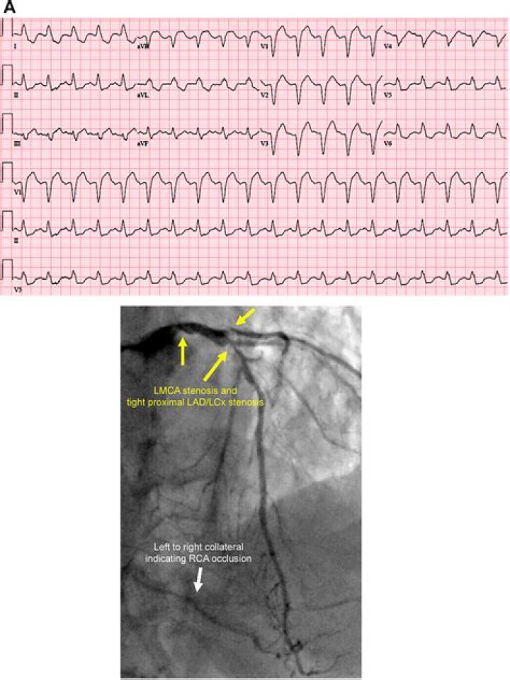 Will echocardiogram show artery blockage?
